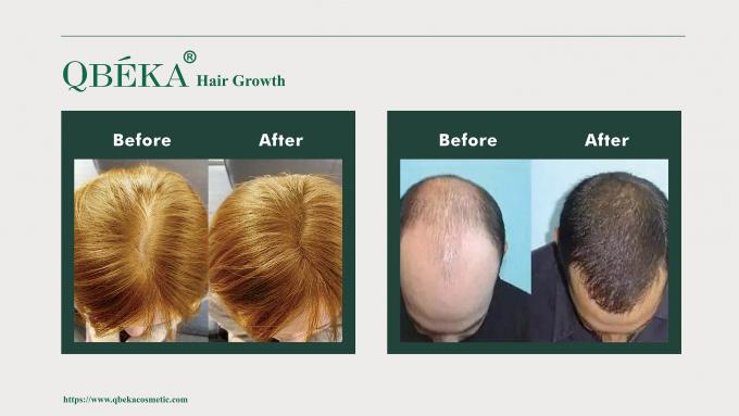 80 ml GMPC setiap hari Pengobatan standar untuk rambut rontok dan rambut rontok pada pria 10