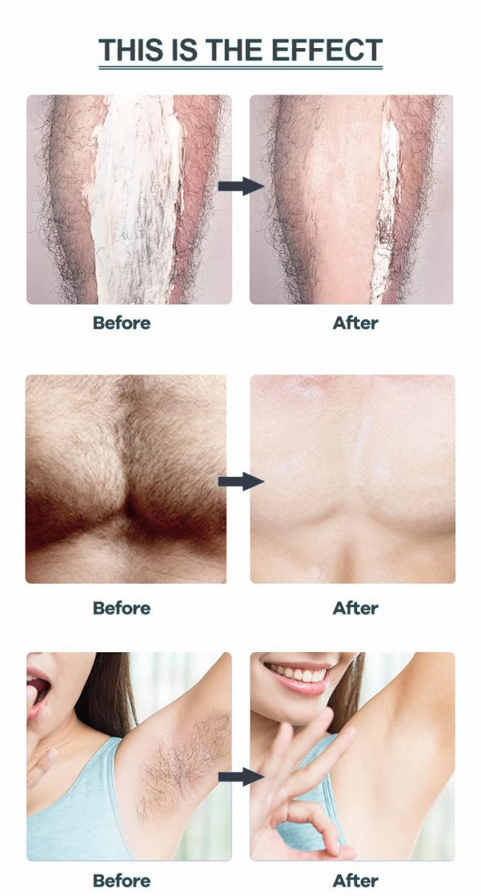 Penghapusan rambut lembut untuk bagian intim ketiak kaki dan lengan Tidak ada iritasi atau kemerahan 10