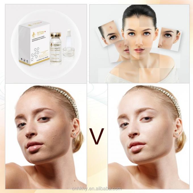 Menghilangkan bekas jerawat dengan QBEKA Happy Cosmetics Levorotatory VC Original Liquid Bio Serum 0